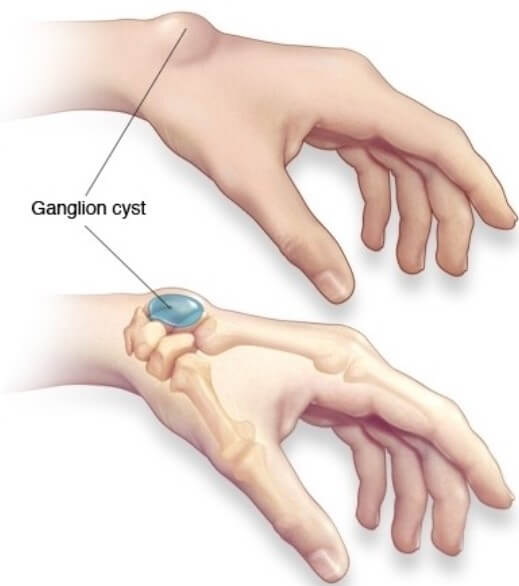 결절종 염증 위치 설명