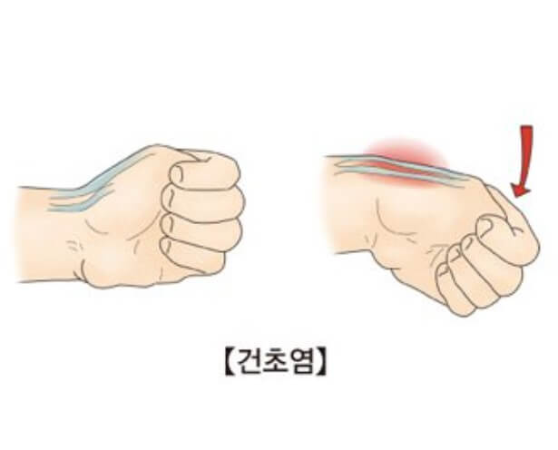 엄지손가락 건초염 진단하는 방법 설명